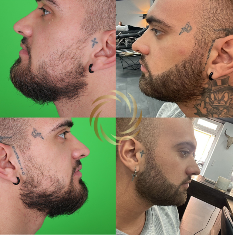 przeszczep zarostu 1 5