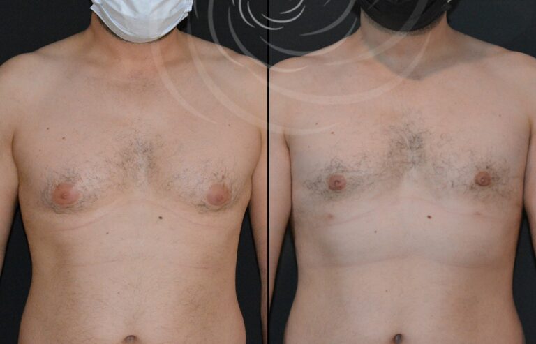 redukcja ginekomastii 1 1