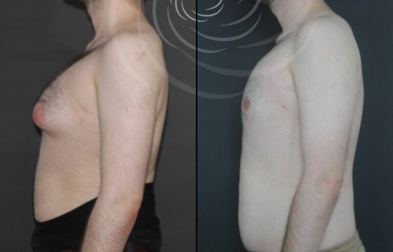 redukcja ginekomastii 1 10