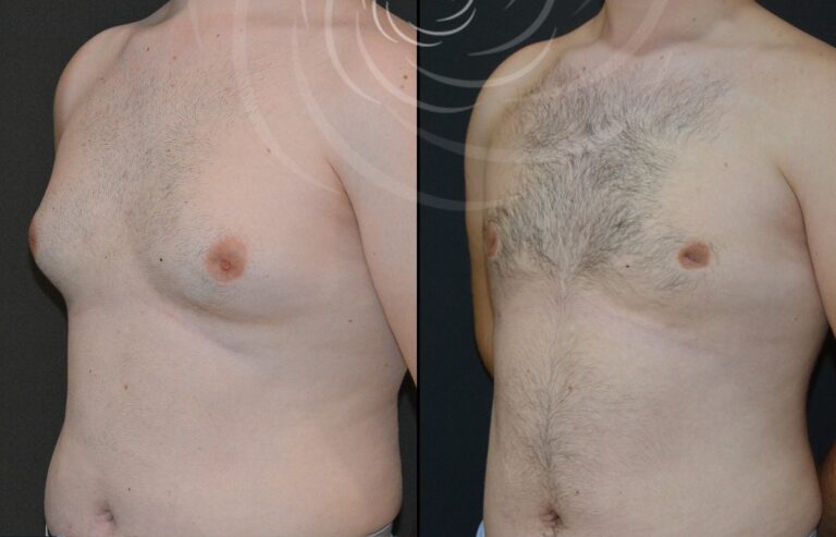redukcja ginekomastii 1 11