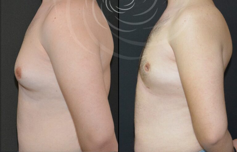 redukcja ginekomastii 1 12
