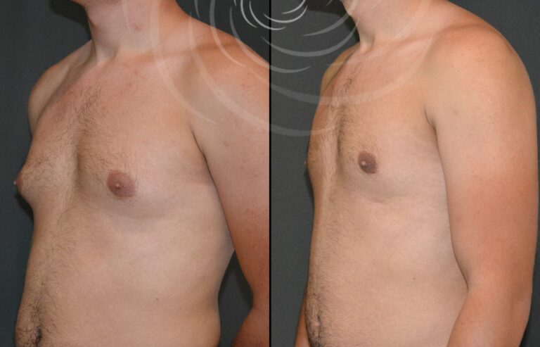 redukcja ginekomastii 1 2