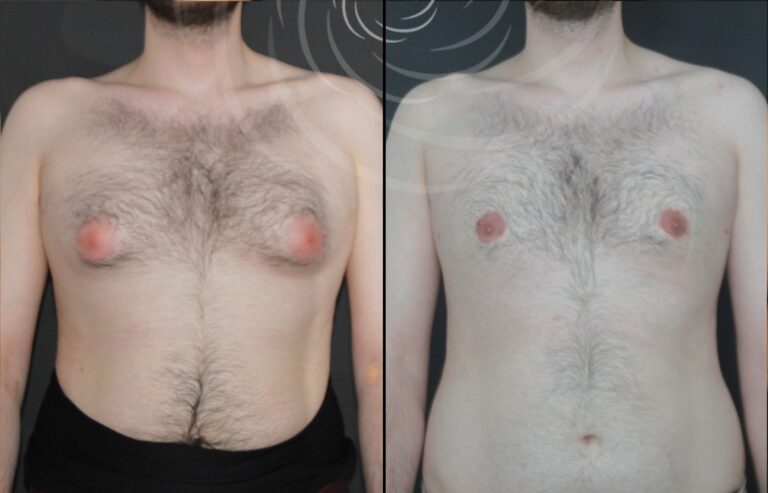 redukcja ginekomastii 1 3