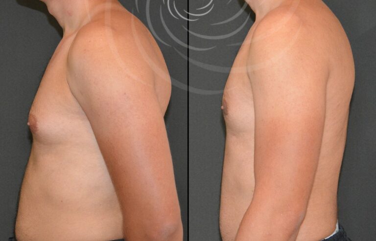 redukcja ginekomastii 1 4