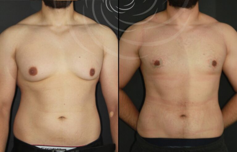 redukcja ginekomastii 1 5