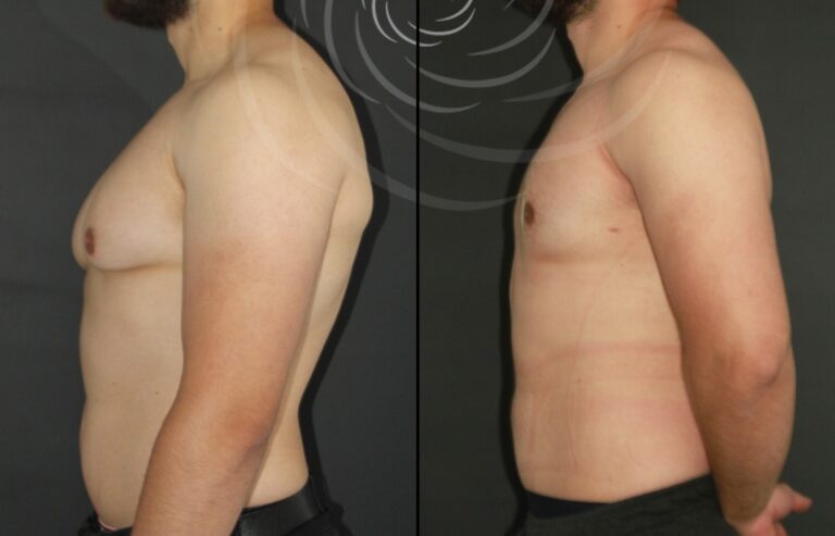 redukcja ginekomastii 1 6