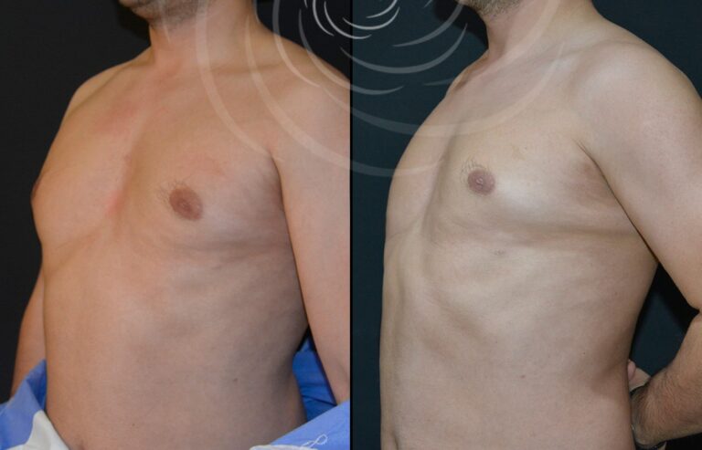 redukcja ginekomastii 1 6