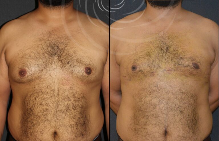 redukcja ginekomastii 1 7