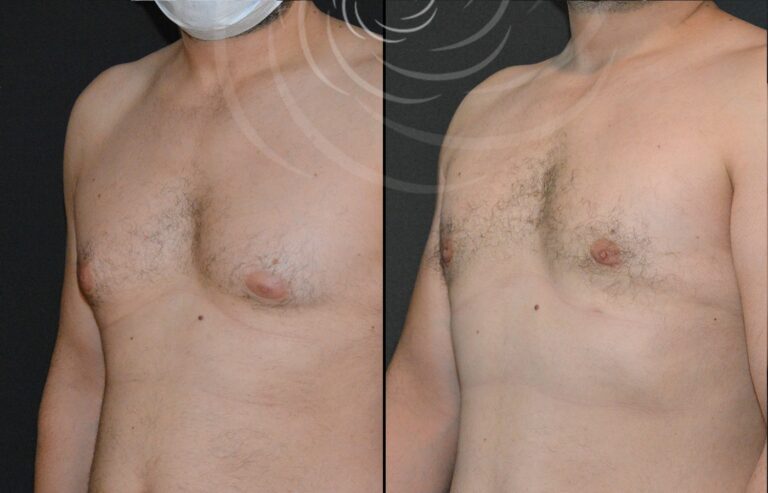 redukcja ginekomastii 1 8